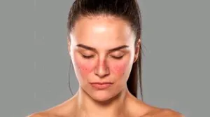Perempuan Perlu Tahu Penyakit Lupus
