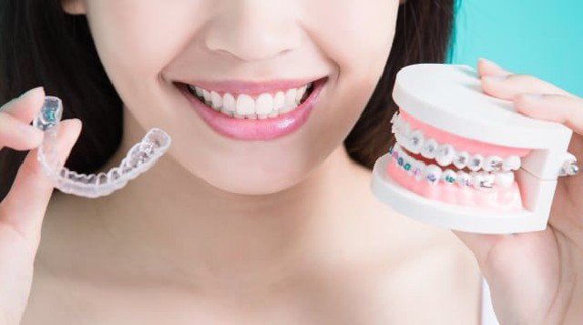 Dengan Teknologi 3D Tidak Perlu Lagi Pakai Kawat Gigi