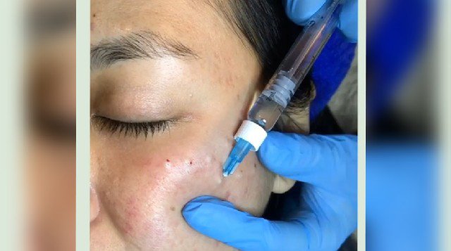 Atasi Bekas Jerawat dengan Perawatan Rejuran dari Korea