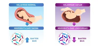 Imunitas Anak Lahir Caesar Harus Optimal