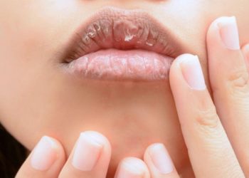 Penyebab Bibir Kering dan Pecah-pecah Serta Solusinya