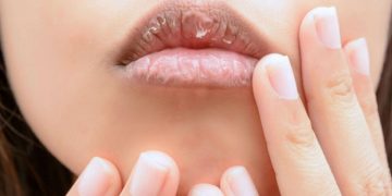 Penyebab Bibir Kering dan Pecah-pecah Serta Solusinya