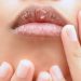 Penyebab Bibir Kering dan Pecah-pecah Serta Solusinya