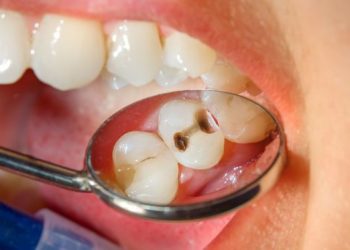 Cegah Gigi Berlubang dengan Rutin Sikat Gigi