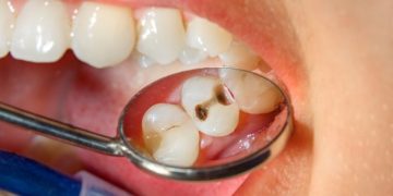 Cegah Gigi Berlubang dengan Rutin Sikat Gigi