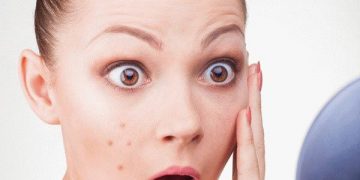 5 Makanan Berikut Bisa Memperparah Jerawat_Womanindonesia.jpg