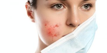 Cara mudah hempas bekas jerawat yang membandel - Womanindonesia.co.id