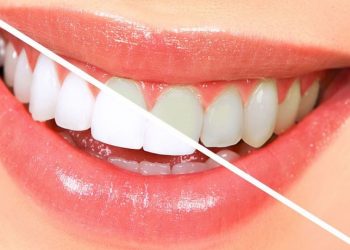 3 Hal yang Harus Dihindari Ketika Bleaching Gigi di Rumah_womanindonesia.jpg