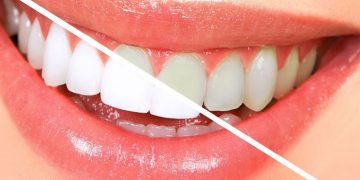 3 Hal yang Harus Dihindari Ketika Bleaching Gigi di Rumah_womanindonesia.jpg