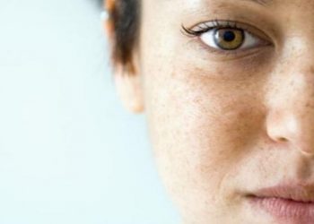 4 Penyebab Flek Hitam di Wajah_womanindonesia.co.id