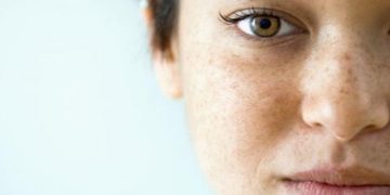 4 Penyebab Flek Hitam di Wajah_womanindonesia.co.id