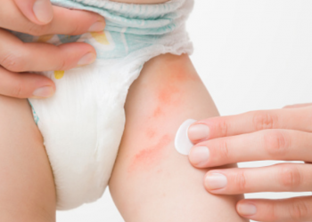 4 Cara Mencegah Ruam Popok Bayi Dengan Kulit Sensitif_womanindonesia.co.id