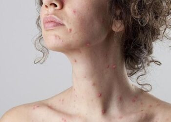 Waspada Cacar Monyet, Kenali Gejala dan Resikonya_womanindonesia.co.id