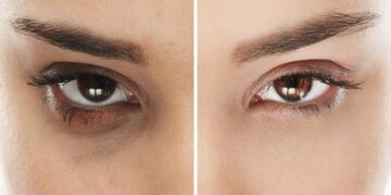 Simak Cara Menghilangkan Kantung Mata dengan 8 Bahan Alami Berikut_womanindonesia.co.id