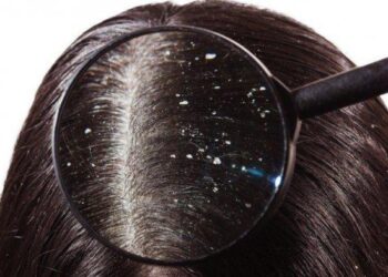 6 Makanan yang Perlu Dihindari untuk Mengurangi Ketombe_womanindonesia.co.id