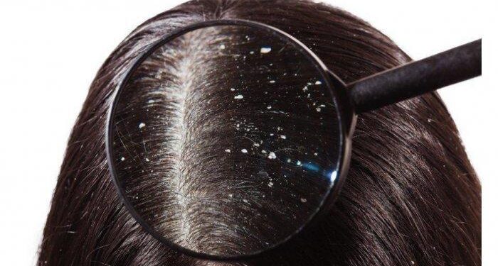 6 Makanan yang Perlu Dihindari untuk Mengurangi Ketombe_womanindonesia.co.id