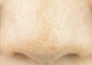 Perbedaan Komedo Putih dan Komedo Hitam_womanindonesia.co.id