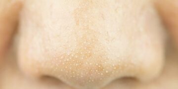 Perbedaan Komedo Putih dan Komedo Hitam_womanindonesia.co.id