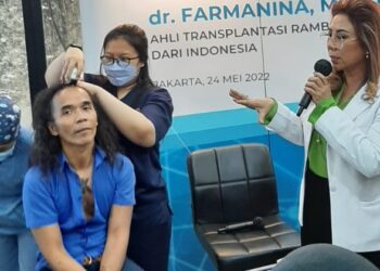 Transplantasi Rambut Metode DHI Terbaik Dunia Hadir di Indonesia_womanindonesia.co.id