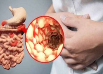 Mengenal Radang Usus yang Dapat Menjadi Kanker_womanindonesia.co.id