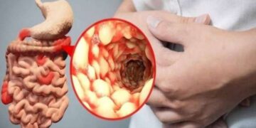 Mengenal Radang Usus yang Dapat Menjadi Kanker_womanindonesia.co.id