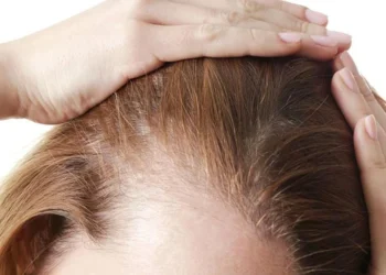 Perbedaan Tanda Kebotakan Pada Perempuan dan Laki-laki_womanindonesia.co.id