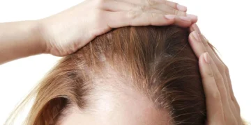 Perbedaan Tanda Kebotakan Pada Perempuan dan Laki-laki_womanindonesia.co.id