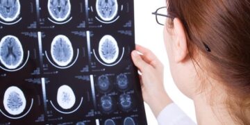 Mengenal Penyakit Gegar Otak dan Efek Sampingnya_womanindonesia.co.id