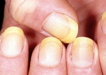 7 Tanda Penyakit yang Terlihat Dari Kuku_womanindonesia.co.id