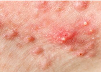 Salah sati jenis jerawat yang tumbuh di pipi