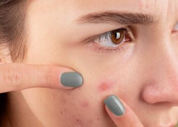 Benarkan Permasalahan Kulit Disebabkan Stres?_womanindonesia.co.id