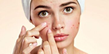 Cara hempas bruntusan - Womanindonesia.co.id