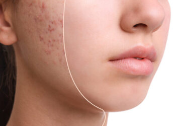 Mengatasi Acne Scar Dengan Laser CO2 Fractional_womanindonesia.co.id