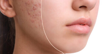 Mengatasi Acne Scar Dengan Laser CO2 Fractional_womanindonesia.co.id