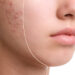Mengatasi Acne Scar Dengan Laser CO2 Fractional_womanindonesia.co.id