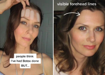 Tanpa Botox, Perempuan 46 Ini Hilangkan Kerutan Pakai Selotip_womanindonesia.co.id