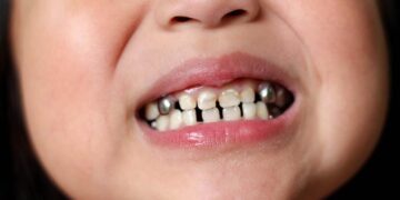 Bahaya Anak Sering Bernapas Lewat Mulut_womanindonesia.co.id