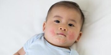 Allergy Awareness Week: Kaitan Alergi Susu Sapi dengan Stunting_Womanindonesia.co.id