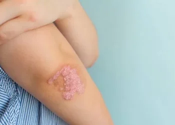 Mengenal Psoriasis: Penyakit Kulit Autoimun yang Perlu Dipahami_Womanindonesia.co.id