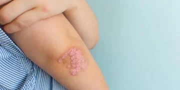 Mengenal Psoriasis: Penyakit Kulit Autoimun yang Perlu Dipahami_Womanindonesia.co.id