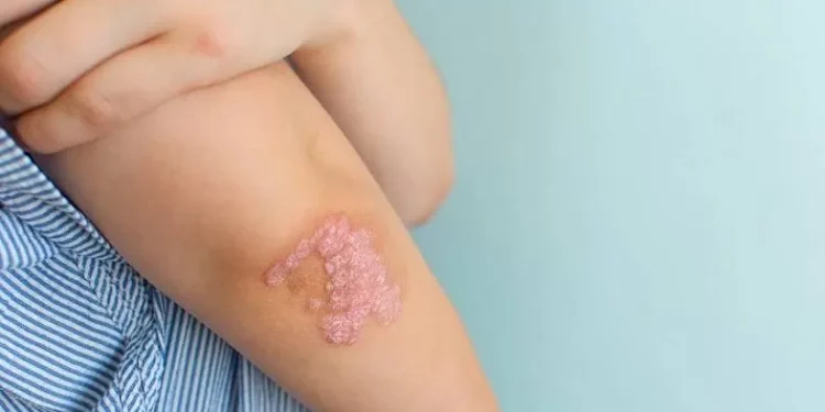 Mengenal Psoriasis: Penyakit Kulit Autoimun yang Perlu Dipahami_Womanindonesia.co.id