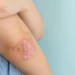 Mengenal Psoriasis: Penyakit Kulit Autoimun yang Perlu Dipahami 9 Mengenal Psoriasis: Penyakit Kulit Autoimun yang Perlu Dipahami_Womanindonesia.co.id