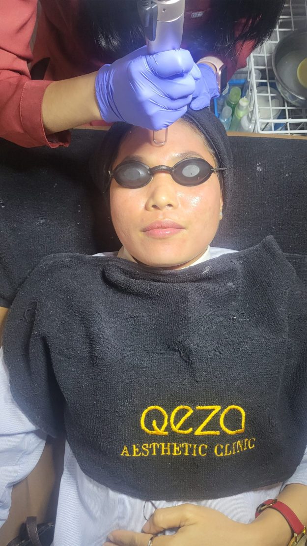 Mengatasi Hiperpigmentasi dengan Pico Laser Rejuve dan Melasma Shoot di Qeza Aesthetic Clinic 4 Mengatasi Hiperpigmentasi dengan Pico Laser Rejuve dan Melasma Shoot di Qeza Aesthetic Clinic_Womanindonesia.co.id
