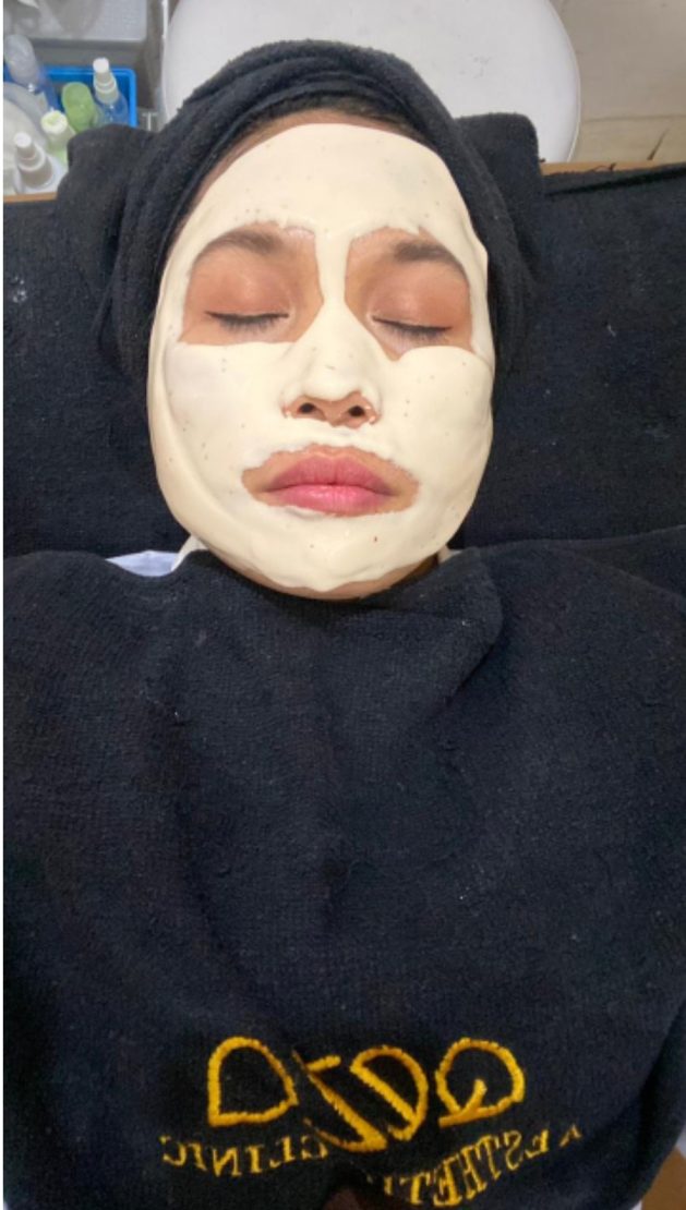 Mengatasi Hiperpigmentasi dengan Pico Laser Rejuve dan Melasma Shoot di Qeza Aesthetic Clinic 3 Mengatasi Hiperpigmentasi dengan Pico Laser Rejuve dan Melasma Shoot di Qeza Aesthetic Clinic_Womanindonesia.co.id