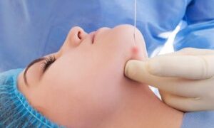 Sequoia Clinic Hadirkan Endolift: Terobosan Perawatan Facelift Non-bedah Pertama di Jakarta_Womanindonesia.co.id