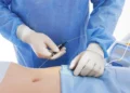 Laser-Assisted Liposuction: Bikin Lemak Hilang dan Kulit Kencang Sekaligus_womanindonesia.co.id